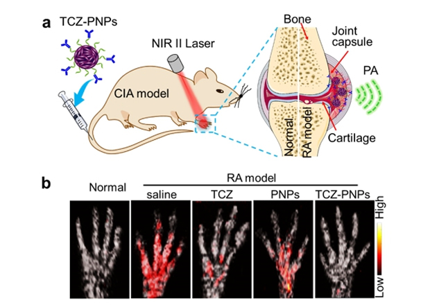 类风湿关节炎光声分子成像与诊疗研究中取得进展